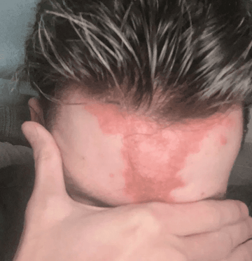 Why Sensitive Skin Deserves Better Self Tan (And How to Avoid Common Mistakes)