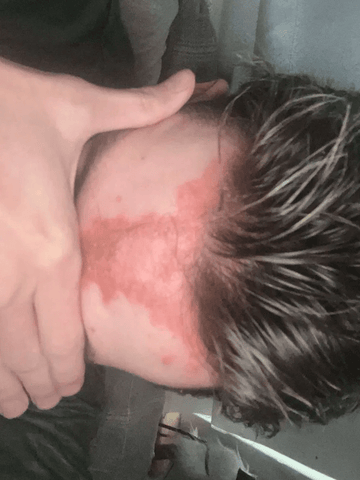 Why We Started RBF Cosmetics: Psoriasis, Fake Tan & Resting Bitch Face